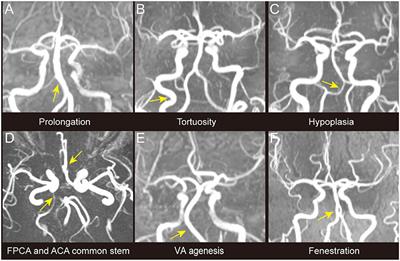 Intracranial Large Artery Abnormalities and Association With Cerebral Small Vessel Disease in CADASIL